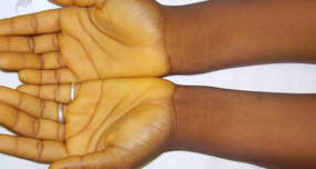 Eating Lots of Carrots Will Turn You Orange