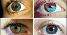 Sectoral Heterochromia: Condition Where One Part of Eye Is Different