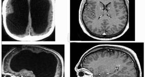 Man Lost 50-75% of His Brain to Water on the Brain, Lived Normally